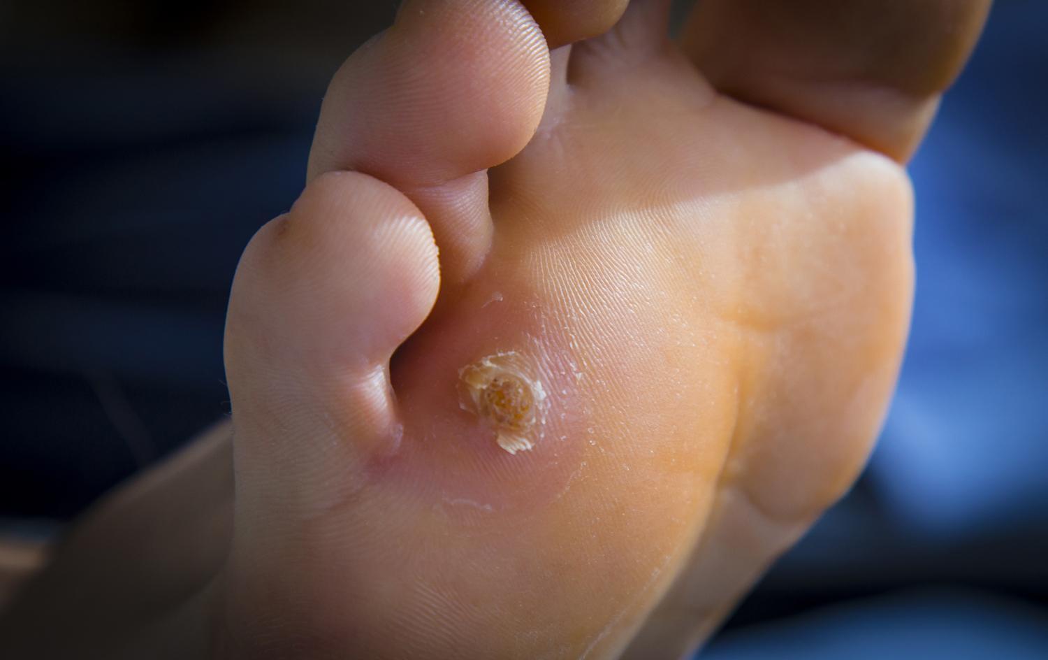 Pied diabetique – soins des pied Pied diabetique - soins des pied