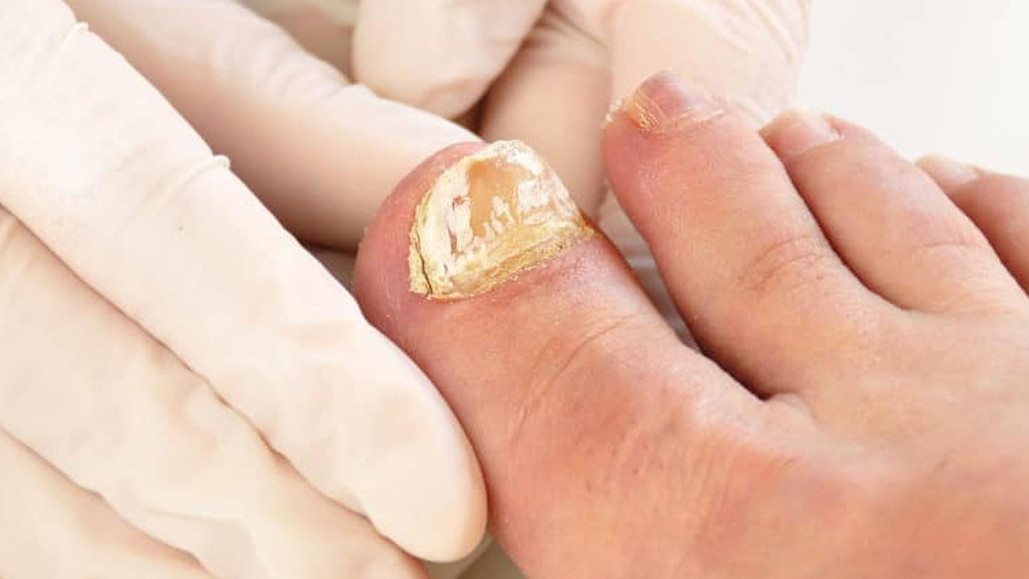 Taille ongles mycosés