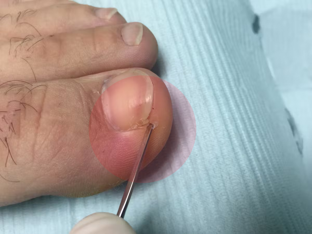 Prevention et soins des ongles incarnés des pieds Prevention et soins des ongles incarnés des pieds