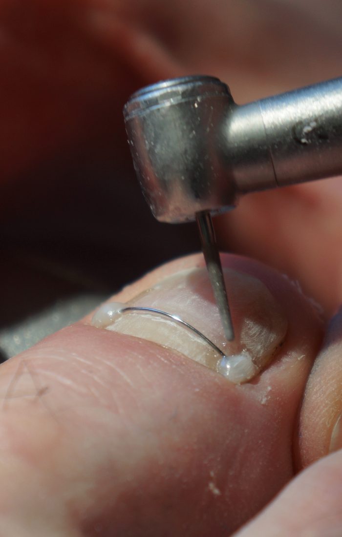 Service de coupl d’ongle incarné Service de couple d'ongle incarné