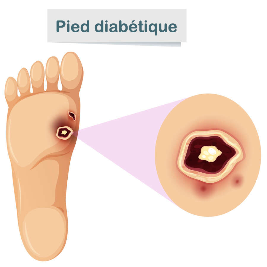 soins Pieds des personnes diabétiques